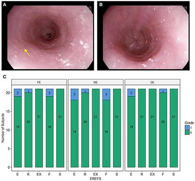 Baseline Gastrointestinal Eosinophilia Is Common in Oral Immunotherapy Subjects With IgE-Mediated Peanut Allergy